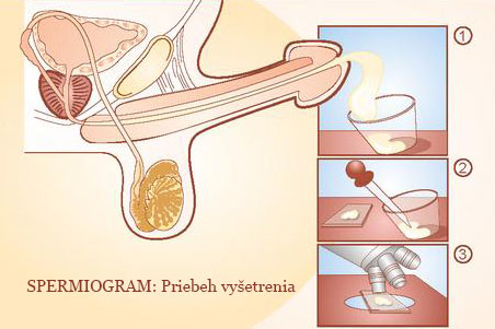 Pre spoľahlivosť výsledkov sa odporúča vyšetrenie spermiogramu opakovať